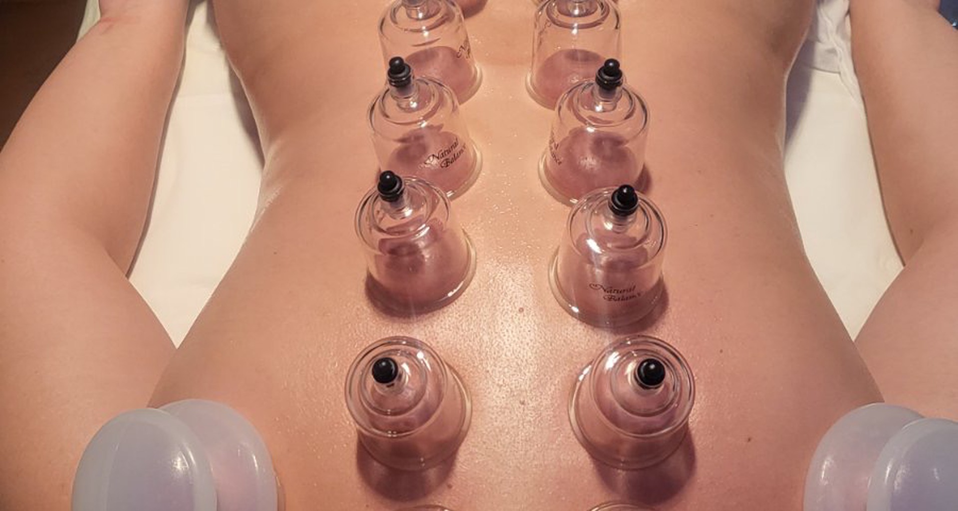 Cupping terapija