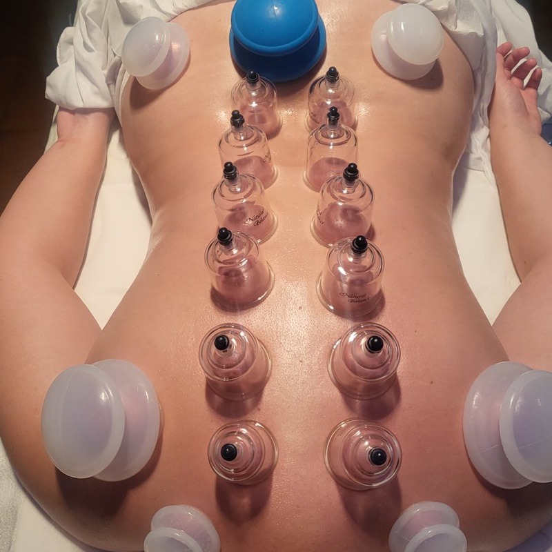 Cupping terapija